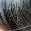 Can Hair Relaxer Kill Lice